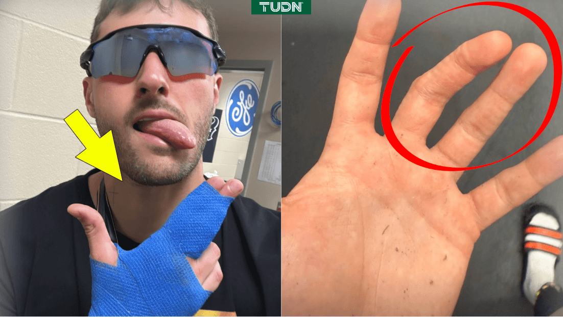 Santi Gimenez muestra la terrible lesión que sufrió en la Copa Oro